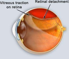 retinal detachment.jpg